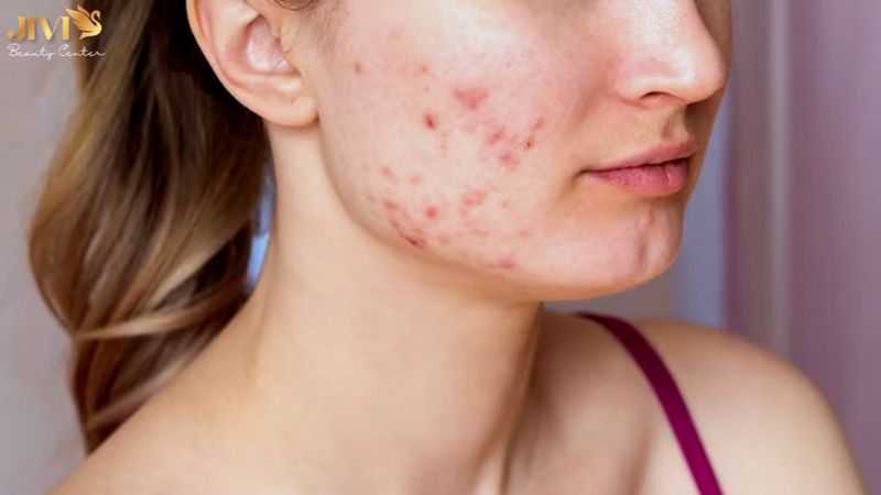 Mụn nội tiết mãn kinh là gì?