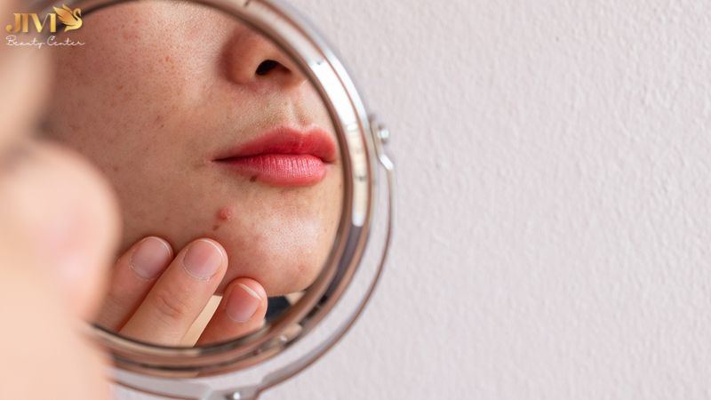 Những thói quen cần tránh để không làm mụn nặng hơn