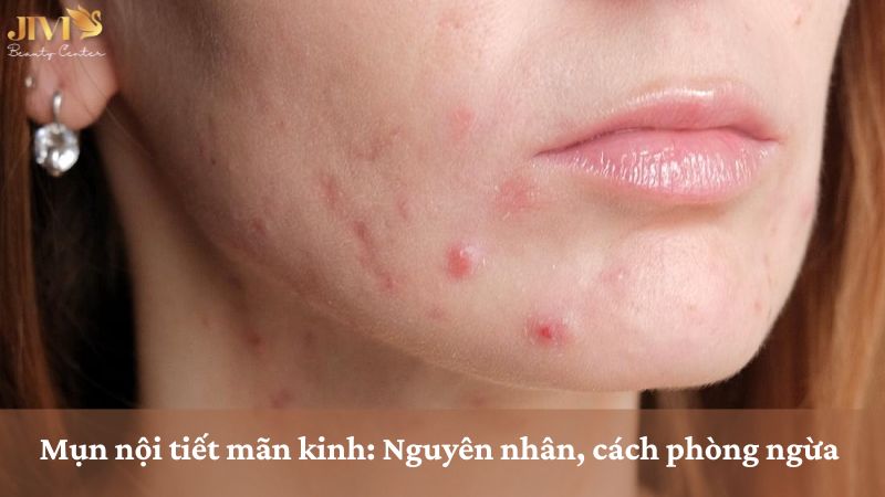 Mụn nội tiết mãn kinh