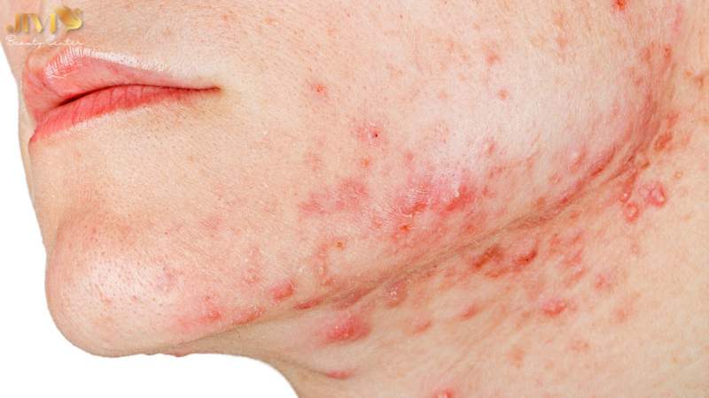 Mụn nội tiết ở cằm là gì?