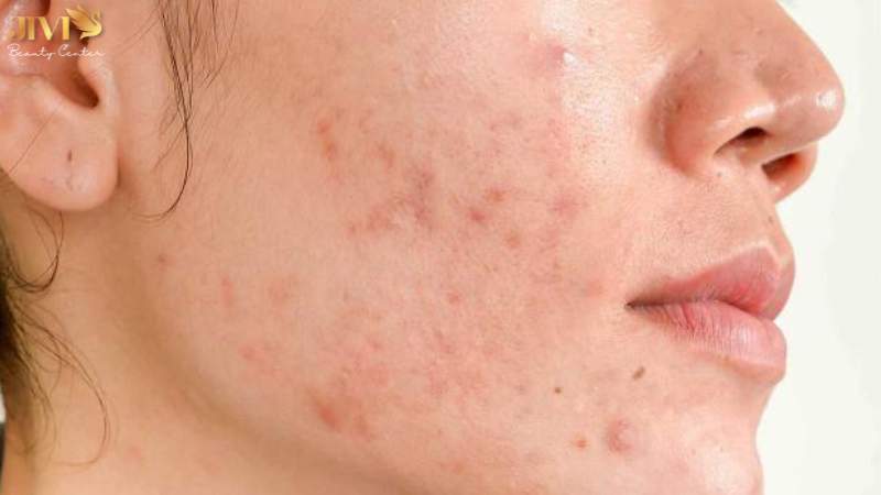 Nguyên nhân gây mụn nội tiết ở cằm