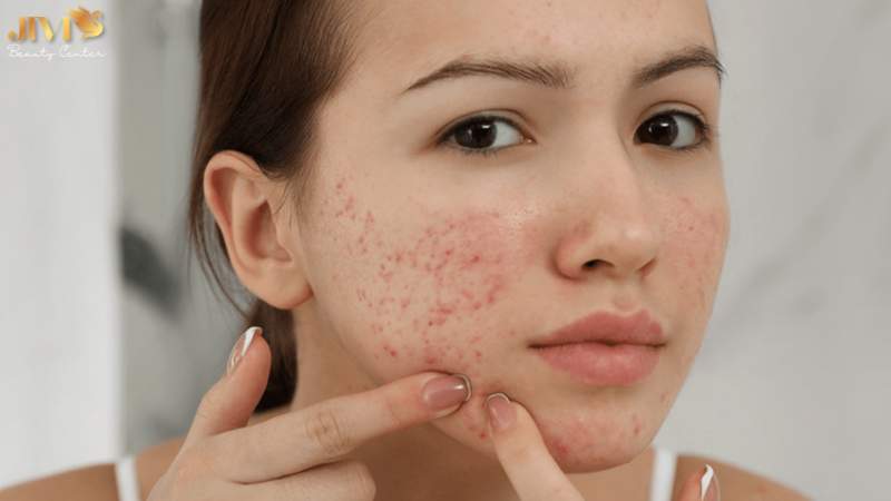 Dấu hiệu nhận biết mụn nội tiết ở cằm