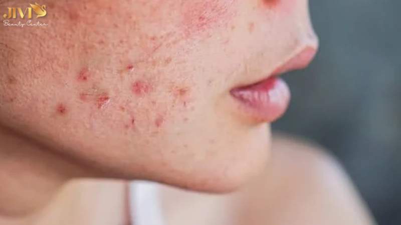 Lưu ý khi điều trị mụn nội tiết ở cằm