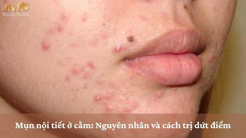 mụn nối tiết ở cằm