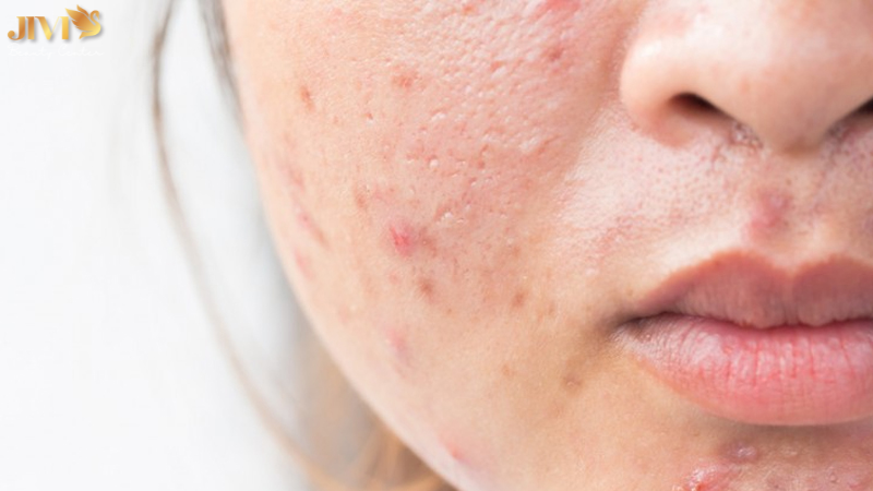 Mụn nội tiết ở má là gì?