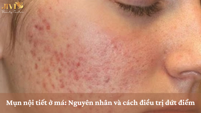 mụn nội tiết ở má