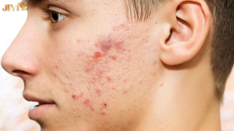 Nguyên nhân gây mụn nội tiết ở má