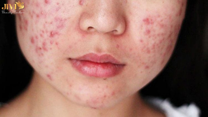 Lưu ý khi điều trị mụn nội tiết ở má