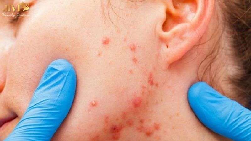 Nguyên nhân gây mụn nội tiết sau sinh