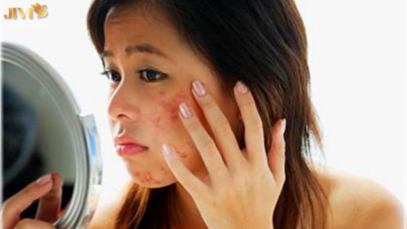 Cách điều trị mụn nội tiết sau sinh an toàn