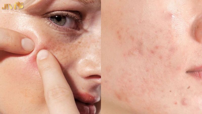 Lưu ý khi điều trị mụn nội tiết sau sinh
