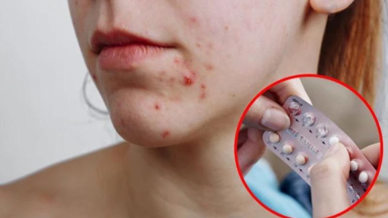 Tây y trị mụn nội tiết hiệu quả không?