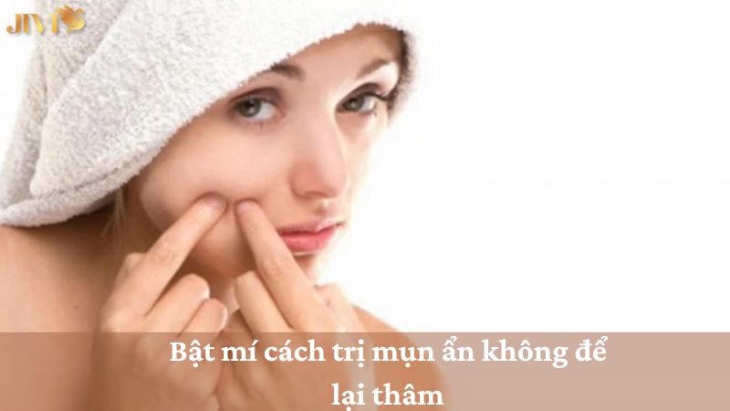 cách trị mụn ẩn không để lại thâm