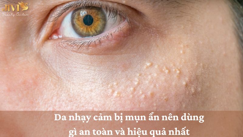 Da nhạy cảm bị mụn ẩn nên dùng