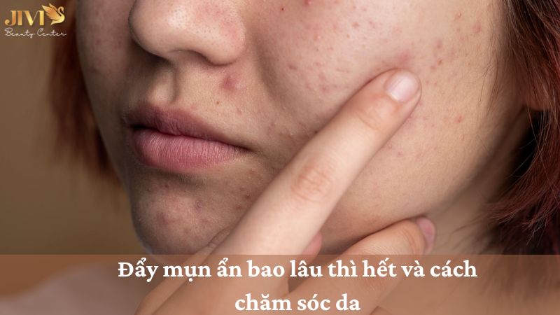 Đẩy mụn ẩn bao lâu thì hết