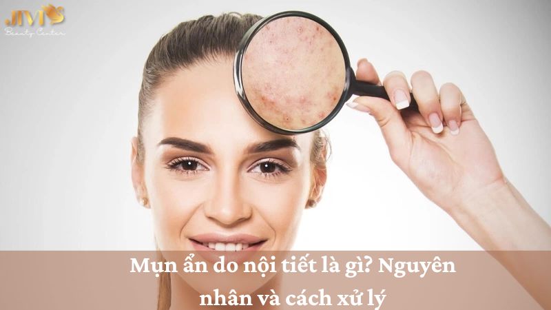 Mụn ẩn do nội tiết