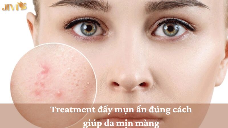 treatment đẩy mụn ẩn