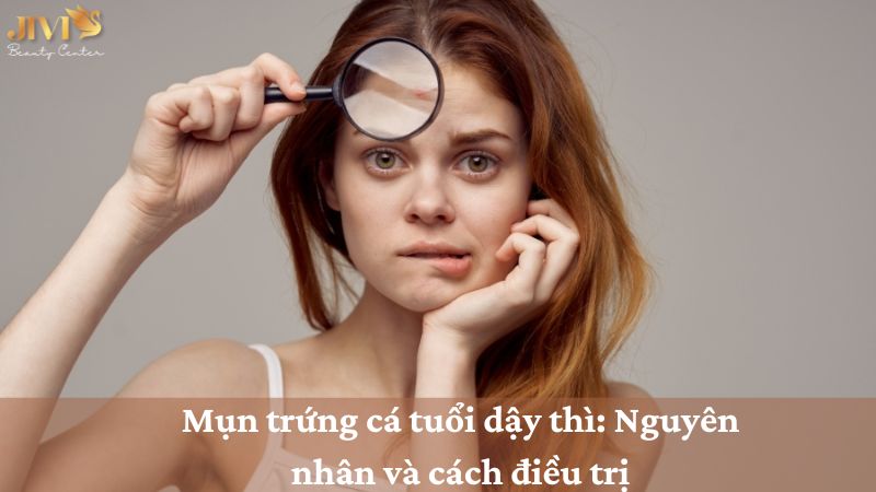 mụn trứng cá tuổi dậy thì