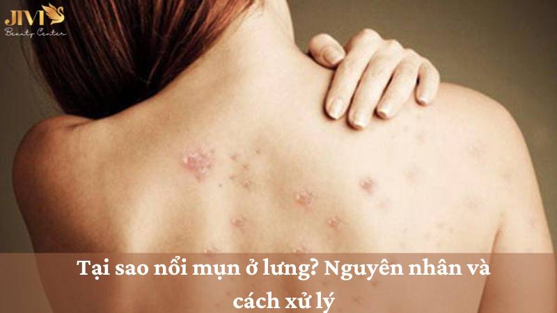 Tại sao nổi mụn ở lưng